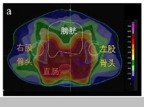 慧软科技放疗计划系统DeepPlan取得新进展